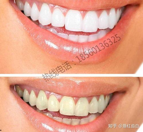 成人牙齿口腔检查方法视频