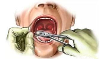 成人大牙怎样拔掉视频,成人大牙拔除操作视频详解