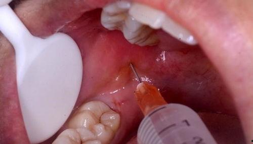 成人大牙怎样拔掉视频,成人大牙拔除操作视频详解